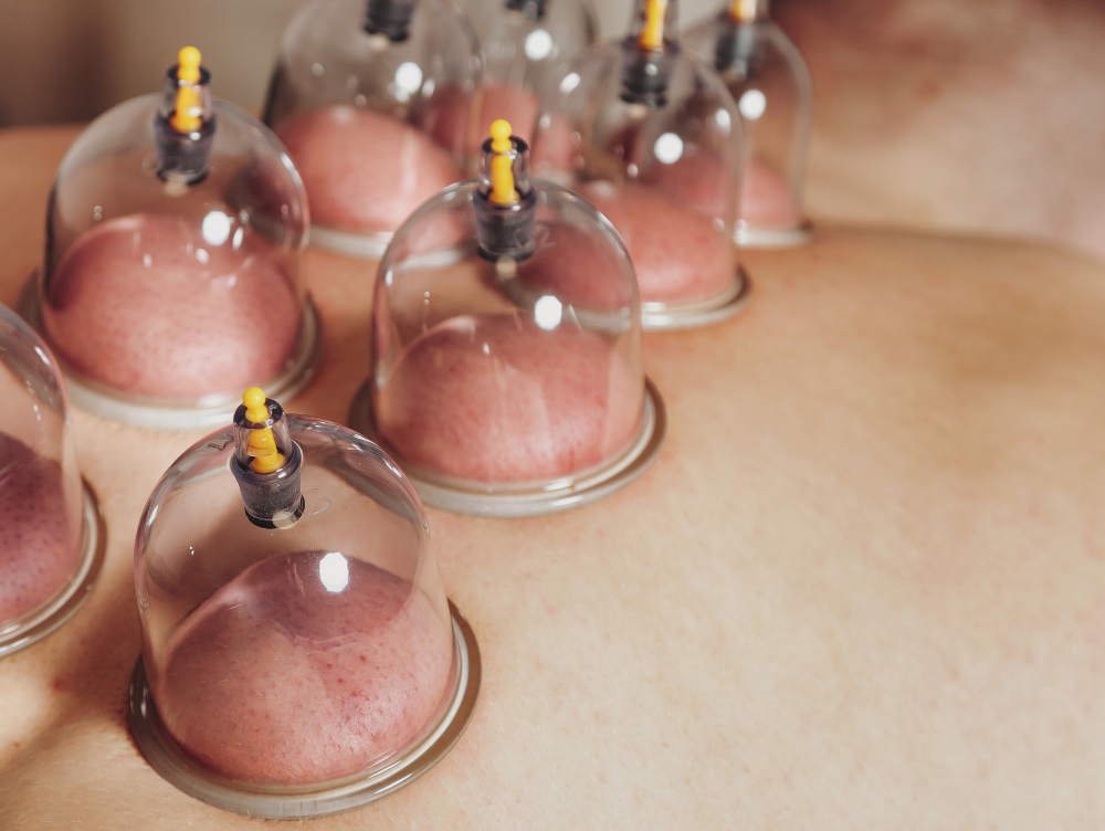 Cupping Massage